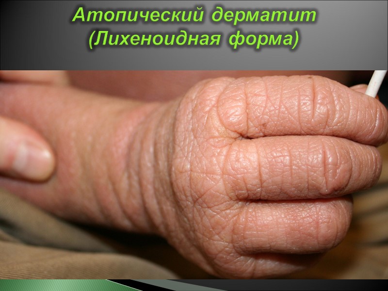Атопический дерматит (Лихеноидная форма)